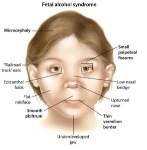 Read more about the article Fetal Alcohol Syndrome: What You Need To Know